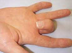 دکتر حسین ارجمند, شیراز, متخصص درد, انگشت ماشه ای, متخصص طب فیزیکی و توانبخشی,trigger finger دکتر حسین ارجمند, شیراز, متخصص درد, انگشت ماشه ای, متخصص طب فیزیکی و توانبخشی,trigger finger